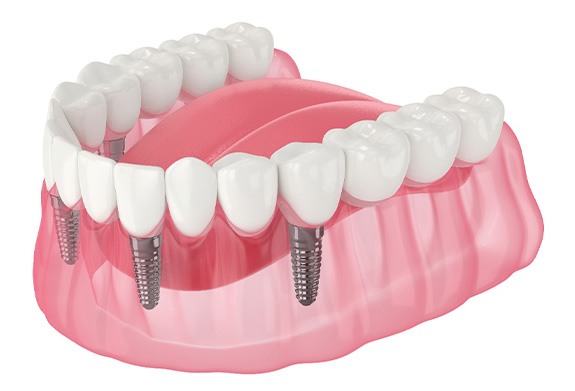 Illustration of implant denture