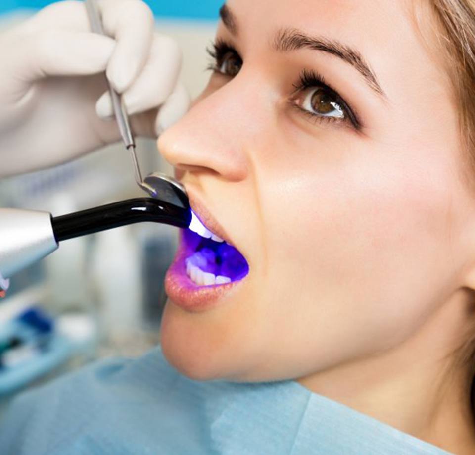 Dentist curing a patient’s dental bonding