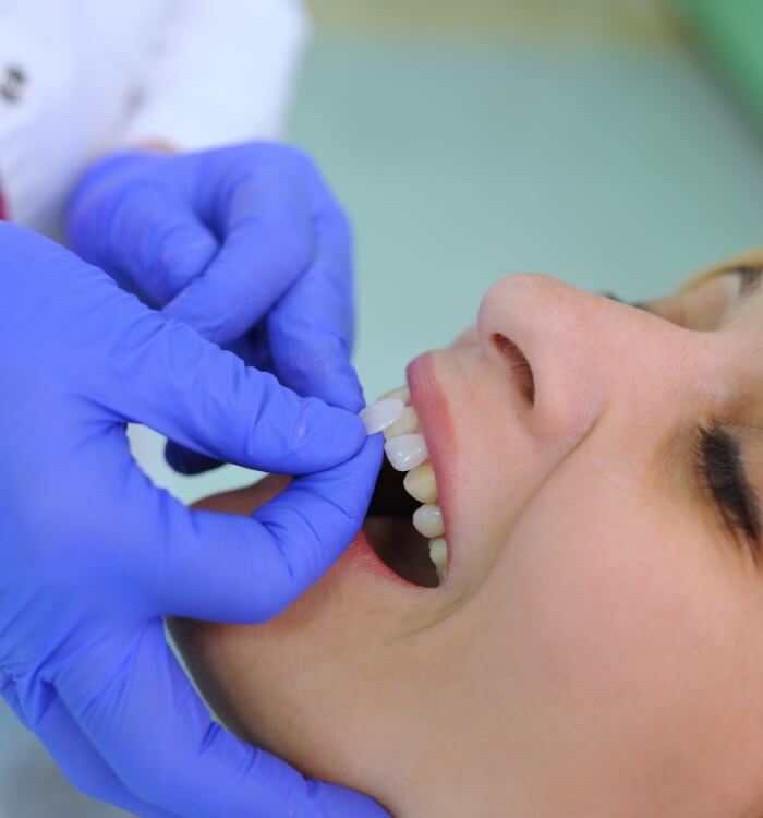 Woman's smile compared with dental bonding color option