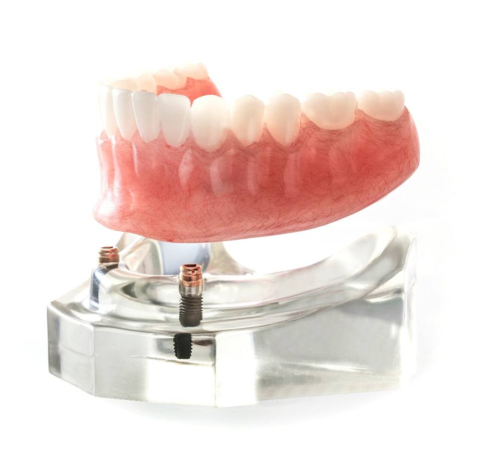 Sample implant denture hovering above transparent clear model jaw with implants