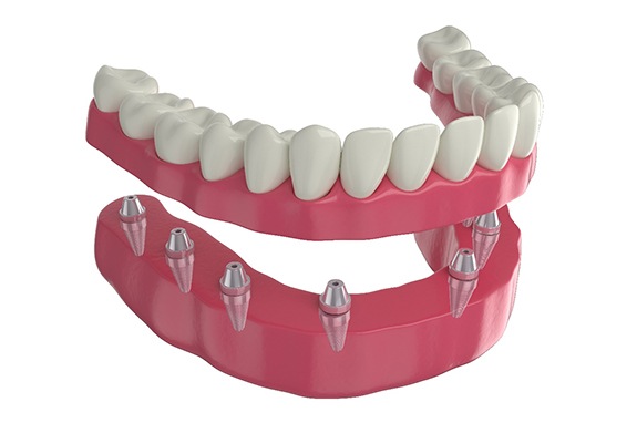 Illustration of implant dentures in lower arch with white background