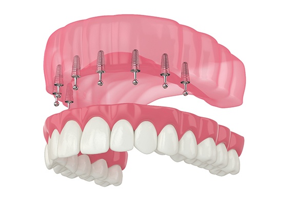 Illustration of bar-retained implant dentures in upper arch with white background