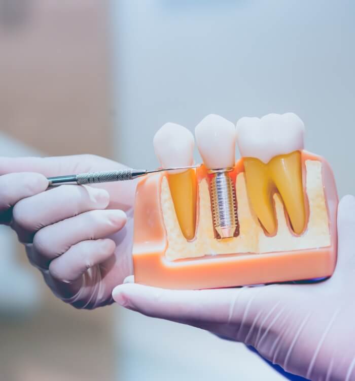 Model smile comparing natural teeth to dental implant supported tooth