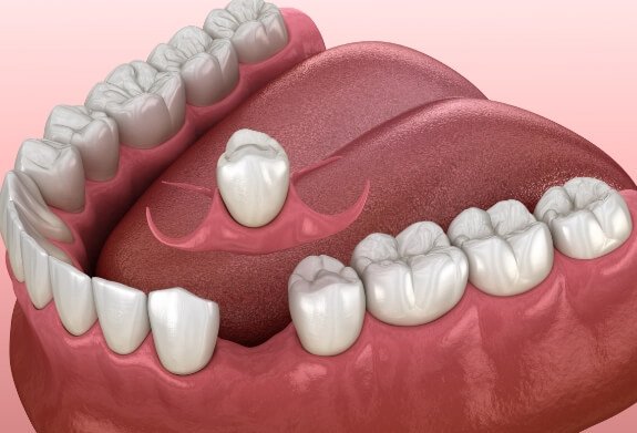 Animated smile during dental implant supported dental crown placement