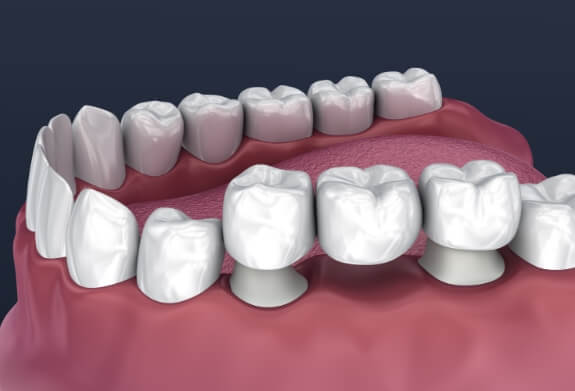 Animated smile during dental implant supported fixed bridge placement