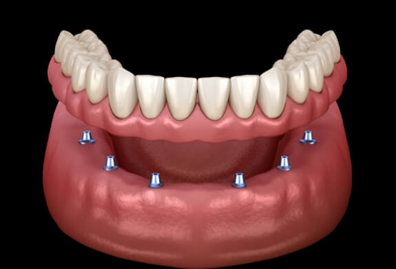 Animated smile during dental implant supported denture placement