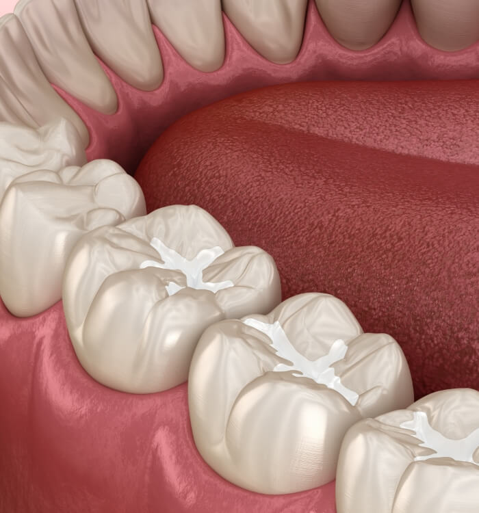 Animated smile with dental sealants in place