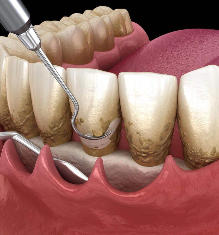 Animated smile during gum disease treatment