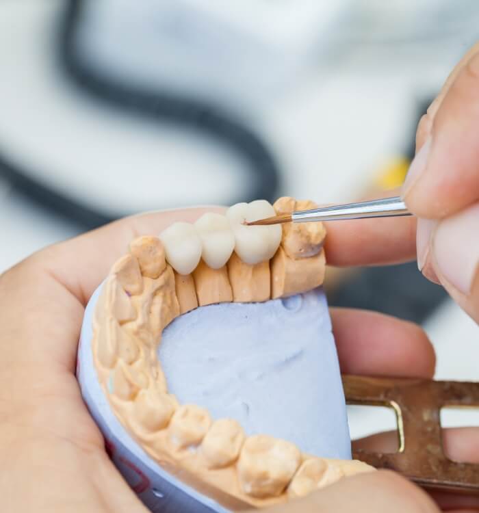 Model smile with dental bridge