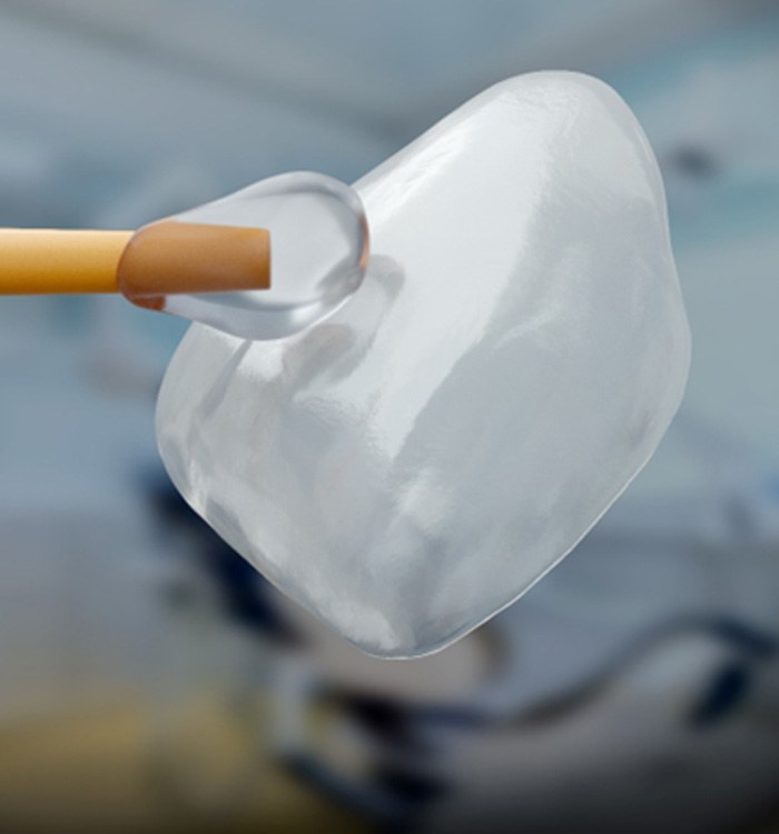 Closeup of a dental veneer prior to placement