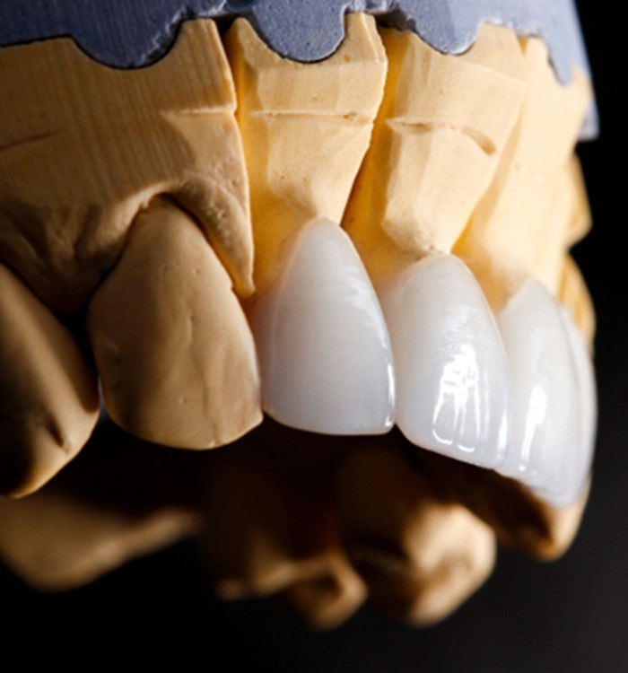 A model of a mouth with veneers placed over top the teeth