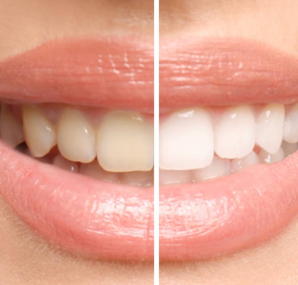 Closeup of smile that’s half whitened
