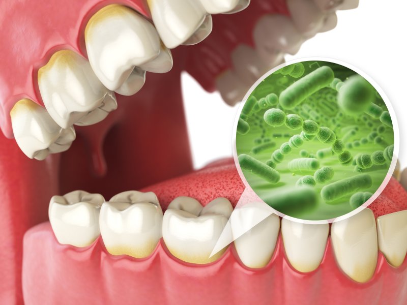 A closeup on a model displaying gum disease