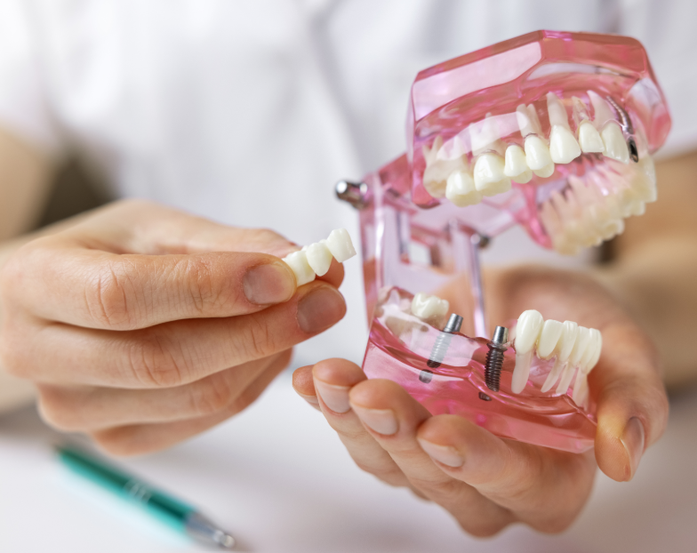 Hands holding model of a mouth with a dental implant